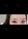 Beautiful eyelids with Hyundai Aesthetics — Korea cost, reviews & before-after | MISOODA