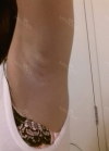 br (t) - 168 50 70 A cup tec 300cc cut / 75d cup after surgery — Korea cost, reviews & before-after | MISOODA