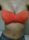 br (t) - 168 50 70 A cup tec 300cc cut / 75d cup after surgery — Korea cost, reviews & before-after | MISOODA