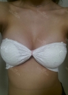 br (t) - 168 50 70 A cup tec 300cc cut / 75d cup after surgery — Korea cost, reviews & before-after | MISOODA
