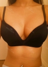 br (t) - 168 50 70 A cup tec 300cc cut / 75d cup after surgery — Korea cost, reviews & before-after | MISOODA