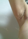 br (t) - 168 50 70 A cup tec 300cc cut / 75d cup after surgery — Korea cost, reviews & before-after | MISOODA