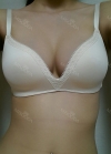 br (t) - 168 50 70 A cup tec 300cc cut / 75d cup after surgery — Korea cost, reviews & before-after | MISOODA