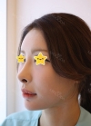 I did rehab surgery on my nose. — Korea cost, reviews & before-after | MISOODA