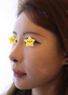I did rehab surgery on my nose. — Korea cost, reviews & before-after | MISOODA