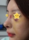 I did rehab surgery on my nose. — Korea cost, reviews & before-after | MISOODA