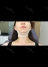 Accu & thread lift — Korea cost, reviews & before-after | MISOODA