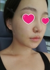 Accu & thread lift — Korea cost, reviews & before-after | MISOODA