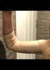 Arm Liposuction with Pretty Body Clinic — Korea cost, reviews & before-after | MISOODA