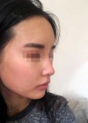 Rhinoplasty, Fat Grafting at BK Plastic Surgery — Korea cost, reviews & before-after | MISOODA