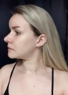 Great service doing Ulthera , Botox and Lip fillers using Misooda — Korea cost, reviews & before-after | MISOODA