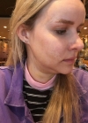 Hello everyone, I wanted to share my experience... — Korea cost, reviews & before-after | MISOODA