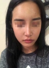 Rhinoplasty, Fat Grafting at BK Plastic Surgery — Korea cost, reviews & before-after | MISOODA