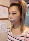 Secondary Rhinoplasty and Thread Lifting in BK Plastic Surgery Hospital in Korea! — Korea cost, reviews & before-after | MISOODA