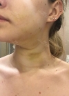 Hello everyone, I wanted to share my experience... — Korea cost, reviews & before-after | MISOODA