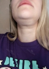 Hello everyone, I wanted to share my experience... — Korea cost, reviews & before-after | MISOODA