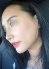 Rhinoplasty, Fat Grafting at BK Plastic Surgery — Korea cost, reviews & before-after | MISOODA