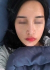 Rhinoplasty, Fat Grafting at BK Plastic Surgery — Korea cost, reviews & before-after | MISOODA