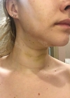 Hello everyone, I wanted to share my experience... — Korea cost, reviews & before-after | MISOODA