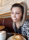 Secondary Rhinoplasty and Thread Lifting in BK Plastic Surgery Hospital in Korea! — Korea cost, reviews & before-after | MISOODA