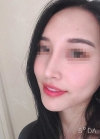 Rhinoplasty, Fat Grafting at BK Plastic Surgery — Korea cost, reviews & before-after | MISOODA