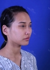 Rhinoplasty, Fat Grafting at BK Plastic Surgery — Korea cost, reviews & before-after | MISOODA