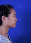 Rhinoplasty, Fat Grafting at BK Plastic Surgery — Korea cost, reviews & before-after | MISOODA
