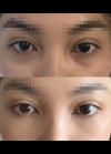 Zygomatic Bone Reduction, Under eye fat reposition — Korea cost, reviews & before-after | MISOODA