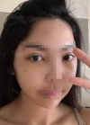 Zygomatic Bone Reduction, Under eye fat reposition — Korea cost, reviews & before-after | MISOODA