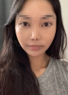 Zygomatic Bone Reduction, Under eye fat reposition — Korea cost, reviews & before-after | MISOODA