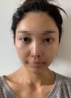 Zygomatic Bone Reduction, Under eye fat reposition — Korea cost, reviews & before-after | MISOODA