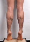 Calf Muscle Reduction — Korea cost, reviews & before-after | MISOODA