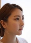 facial liposuction — Korea cost, reviews & before-after | MISOODA
