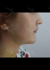facial liposuction — Korea cost, reviews & before-after | MISOODA