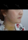 facial liposuction — Korea cost, reviews & before-after | MISOODA