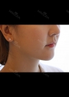 facial liposuction — Korea cost, reviews & before-after | MISOODA