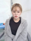 Dual Epi + Nasap Tip Correction + Lip Filler — Korea cost, reviews & before-after | MISOODA