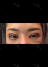 Double eyelids revision only 1 week at Topface! — Korea cost, reviews & before-after | MISOODA