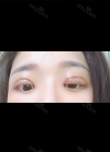 Double eyelids revision only 1 week at Topface! — Korea cost, reviews & before-after | MISOODA