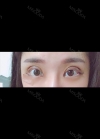 Double eyelids revision only 1 week at Topface! — Korea cost, reviews & before-after | MISOODA
