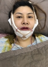 Vline, Cheekbone, Acculift Review at View — Korea cost, reviews & before-after | MISOODA