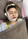 Vline, Cheekbone, Acculift Review at View — Korea cost, reviews & before-after | MISOODA