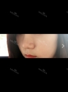 Consulting with the fanous nose revisioning clinic, O&Young — Korea cost, reviews & before-after | MISOODA