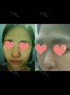 Nose Review! From a low bridge big nose to a desired nose!~~ — Korea cost, reviews & before-after | MISOODA