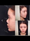 Bye Bye an ugly nose — Korea cost, reviews & before-after | MISOODA