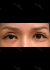 Review the 365000 costing eyes revision — Korea cost, reviews & before-after | MISOODA