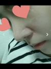 Nose Review! From a low bridge big nose to a desired nose!~~ — Korea cost, reviews & before-after | MISOODA