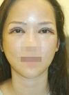 Review the 365000 costing eyes revision — Korea cost, reviews & before-after | MISOODA