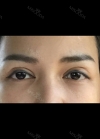 Review the 365000 costing eyes revision — Korea cost, reviews & before-after | MISOODA