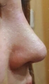 A very satisfied first time nose, I will not need any revision ~~~ — Korea cost, reviews & before-after | MISOODA